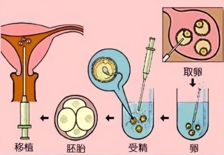 试管婴儿借卵是什么意思_试管婴儿借卵:解析意义